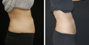 Non-Invasive Body Contouring 